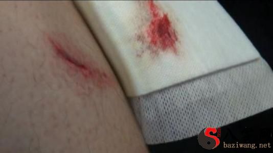 梦见自己腿流血